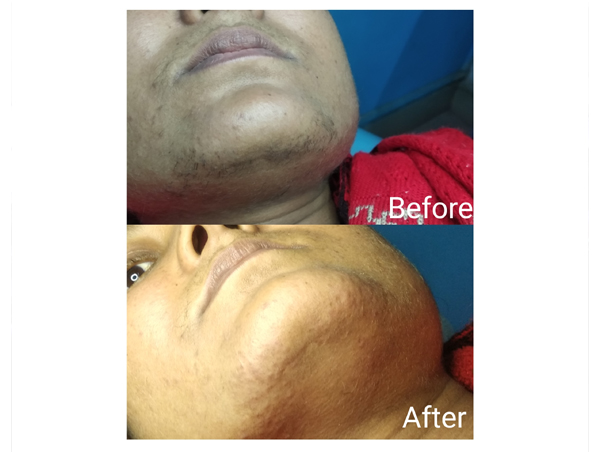 Furless Electroysis | +919891479932 | Furless Electroysis, BEARD SHAPING in  south extension, CHIN HAIR REMOVAL in south extension, EYEBROW SHAPING in  south extension, HAND HAIR REMOVAL in south extension, LEG HAIR REMOVAL