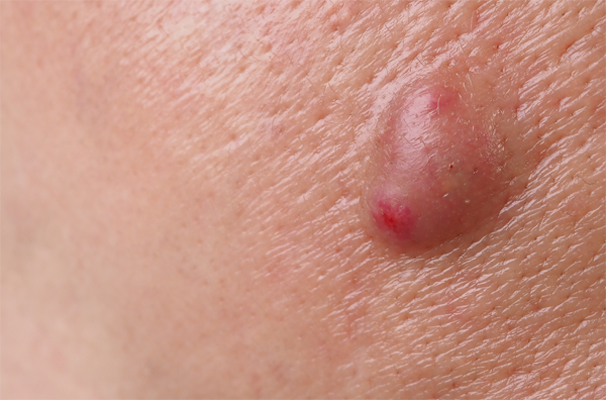 Sebaceous Cysts