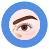 Xanthelasma